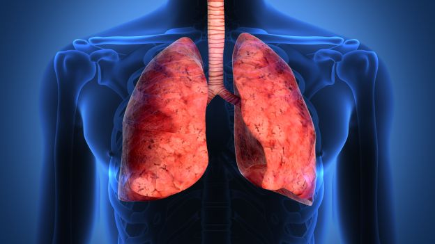 Nuova tecnica per combattere il cancro al polmone. Si  aggirano i “trucchi” delle cellule tumorali